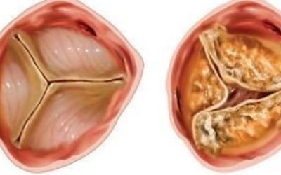 "소염진통제 세레브렉스, 대동맥 협착 위험↑"