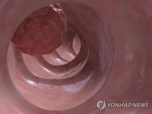 세브란스병원 "대변 DNA 분석으로 대장암·용종 90% 예측"