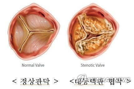 "대동맥 협착, 수술보다 스텐트 시술이 유리"