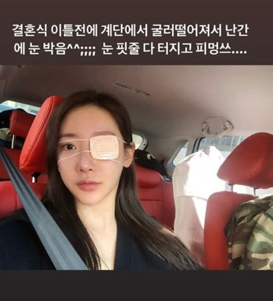 송다예 눈 부상 /사진=인스타그램 