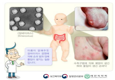 4월 수족구병 환자 증가 예상…손만 잘 씻어도 감염 줄인다