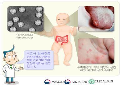 야외활동 증가에 '수족구병' 확산 …"식사·배변 후 손씻기"