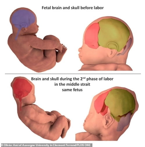 "태아 머리 모양, 분만 때 형태 바뀐다"