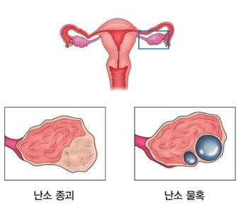 스웨덴 연구팀, 난소암 혈액검사법 개발