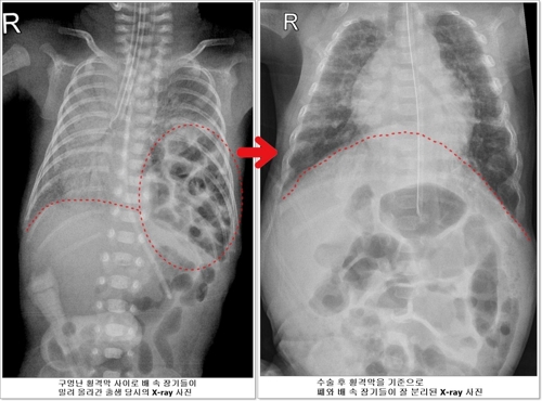 900ｇ 초미숙아 '횡격막 탈장증' 극복하고 건강하게 퇴원