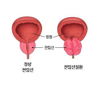 전립선비대, '고속 물총'으로 치료한다