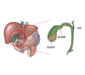 "담석, 주범은 호중구"