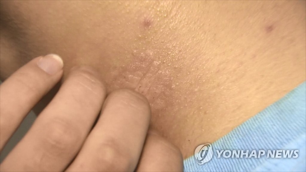 피부질환이 `장 질환` 유발한다?…"유병률 2배 이상"