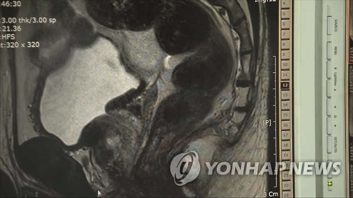 "전립선암 호르몬 치료, 수술보다 사망위험 높다"…무려 3.4배