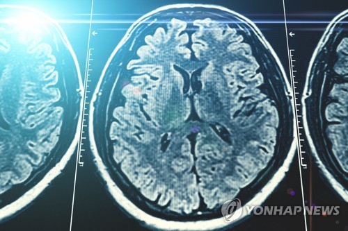 "수술 급한 중증 뇌전증 2만2천명…실제 수술은 年 300건"