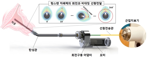 자궁경부암 종양 부위에만 방사선 쏜다…특허 출원