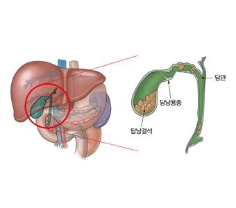 "커피, 많이 마실수록 담석 예방 효과 높아진다" <덴마크 코펜하겐대>