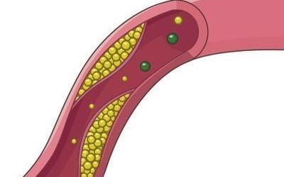"폐경 후 '나쁜' 콜레스테롤 증가한다"