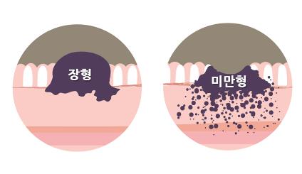 "40세 미만 조기위암, 혈액검사로 미리 알아낼 수 있다"