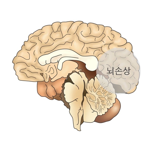 "뇌 외상에 의한 기억장애와 치매 MRI로 구분 가능"