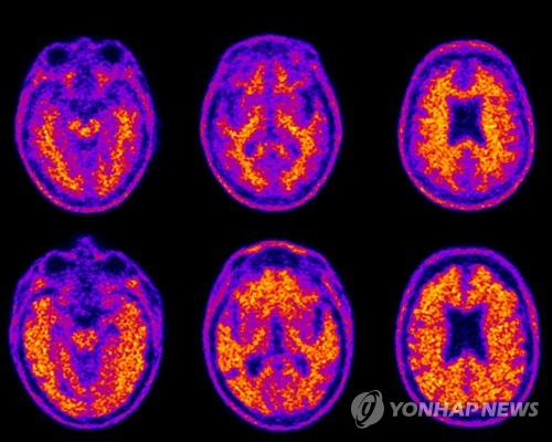 "치매 연구 국가가 주도한다"…9년간 R&D 2000억 투입
