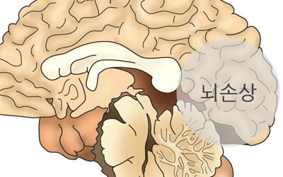 "뇌 외상에 의한 기억장애와 치매 MRI로 구분 가능"