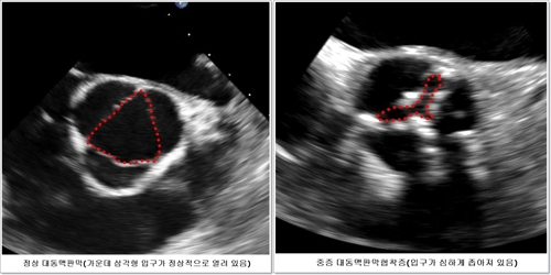 "대동맥판막협착, 무증상도 수술해야"…국내 의료진 NEJM에 논문