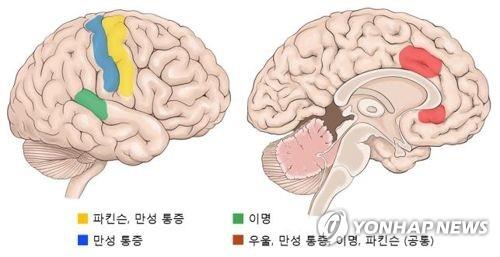 "머릿속 뿌연 '브레인 포그', 염증과 인과관계 있다"