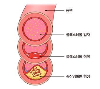 "콜레스테롤로 혈관 좁아진 성인 절반서 대장선종 발견"