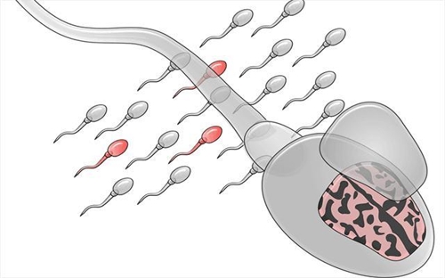 "'드노보 돌연변이' 자폐증 위험, 정자 검사로 진단 가능"