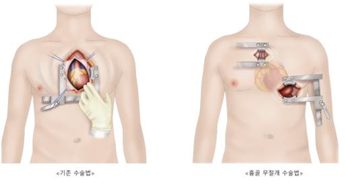 삼성서울병원, 흉골 절단 없이 인공심장 이식 성공