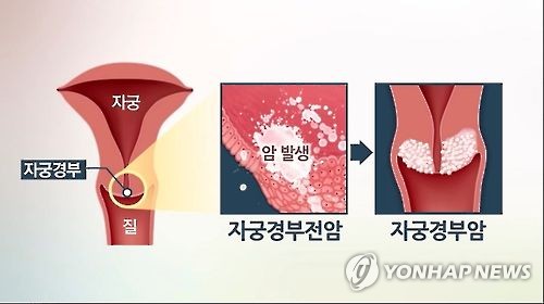 제넥신 "자궁경부전암 치료백신, 수술없이 60% 이상 효과"