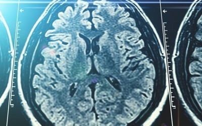 단순 두통에 MRI 땐 본인부담률 80%로 상향…내년 3월 시행