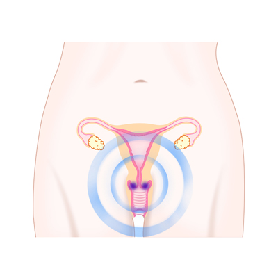 HPV 예방 아닌 치료 백신 개발