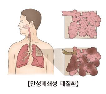 COPD 치료 가능할까…COPD 진행 막는 암 치료제 발견