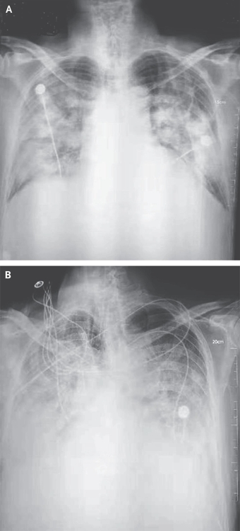 NEJM 논문으로 본 '신종코로나'…"바이러스 배양으로 실체 확인"