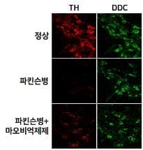 파킨슨병 유발 물질 찾았다…"기존 정설 뒤집어"