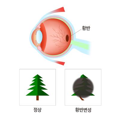 "노인 실명 1위 황반변성, 혈액검사로 조기 발견"