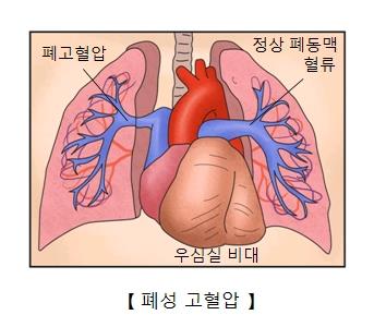 "폐 동맥 고혈압 주범은 腸박테리아"