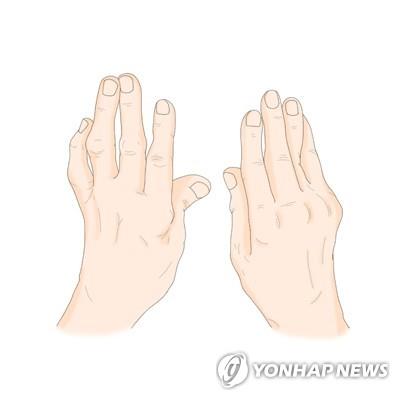 "류머티즘 관절염의 염증 유발에 면역 NK세포가 관여"