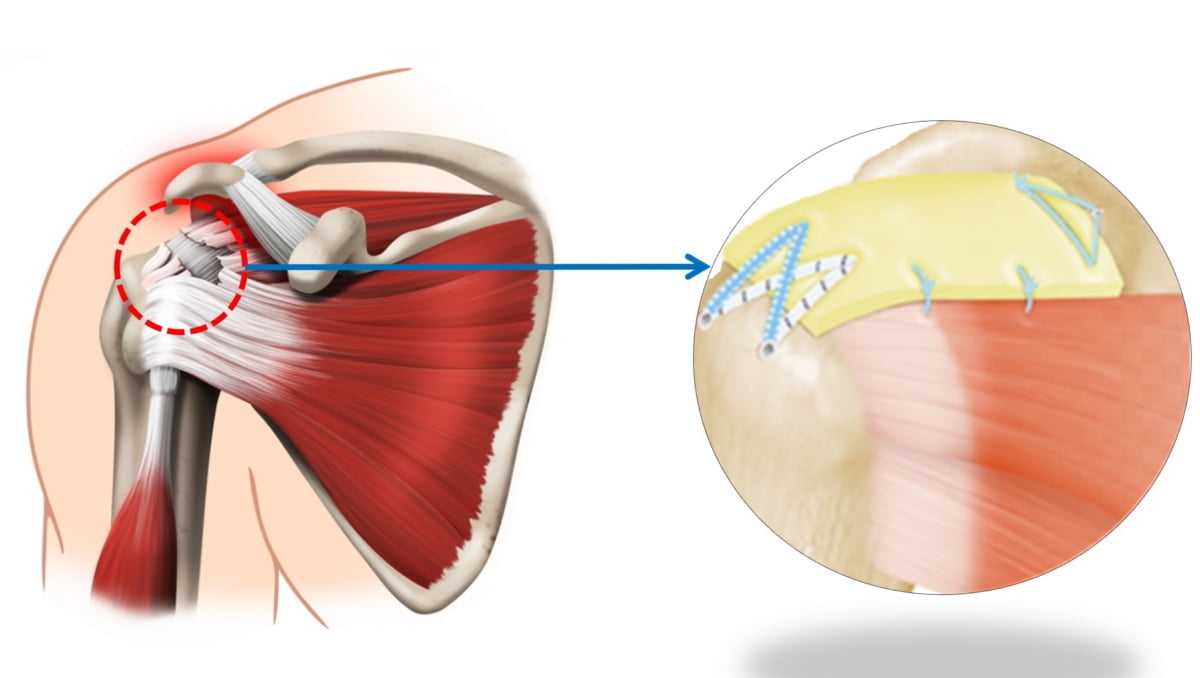 어깨 회전근개파열, 힘줄 변성 및 소실도 이식술 통한 완전봉합 가능