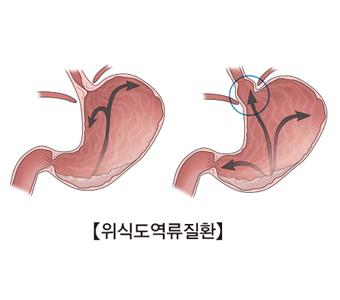 "아이들 PPI 제산제 사용, 골절 위험↑"