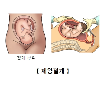 "제왕절개 출산 자녀, 나중 당뇨병 위험↑"