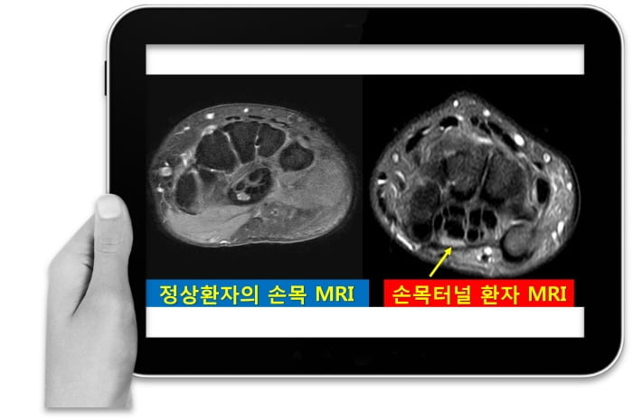 만성 손목터널증후군, 손상된 정중신경 등 다양한 원인과 증상