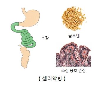 "셀리악병, 독성 화학물질 노출과 연관 있다"