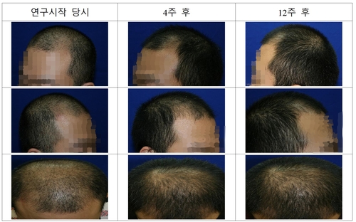 "면역 거부 세포막 없앤 줄기세포로 남성형 탈모증 호전 확인"