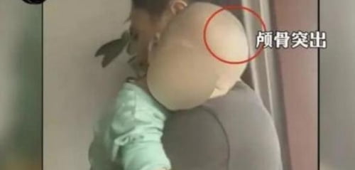 중국 `가짜 분유`에 부작용 속출…아기 머리 기형적으로 커져 "자해 등 이상행동까지"