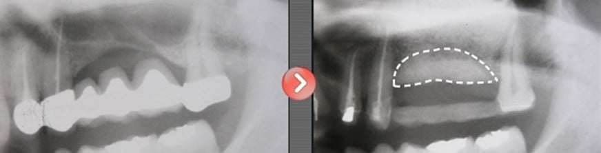 임플란트 재수술 고려시 잇몸뼈 고려해야