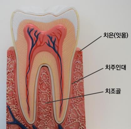 치주질환, 감기 제치고 환자 수 1위…잇몸의 'SOS' 귀 기울여야