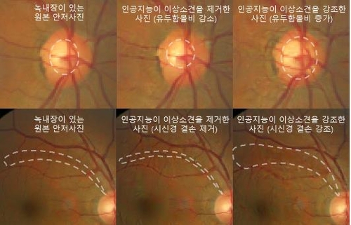 서울대병원, 녹내장 진단하고 설명하는 AI 개발