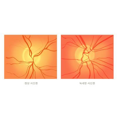 녹내장 치료 '게임 체인저' 시신경 줄기세포 찾아냈다