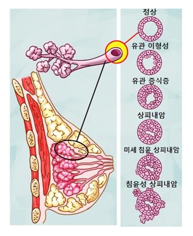 "유방암 소괴절제 방사선치료, 수술 때 한 번으로 충분"