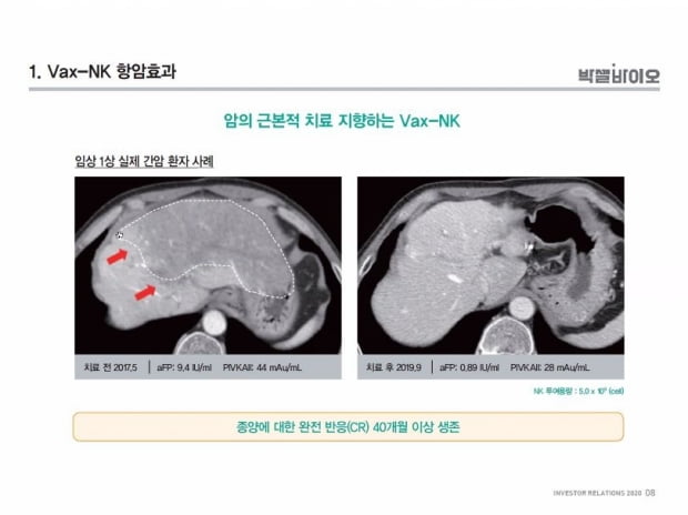 Vax-NK 1상 간암 환자 사례. 출처=박셀바이오 IPO 온라인 간담회 캡쳐.