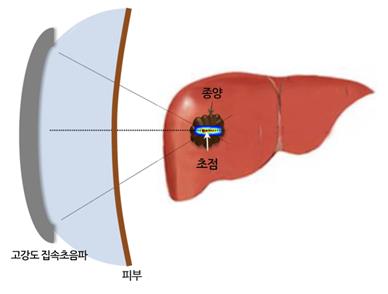 [사이테크 플러스] 초강력 초음파 비외과적 수술의 정확도 저하 원인 규명