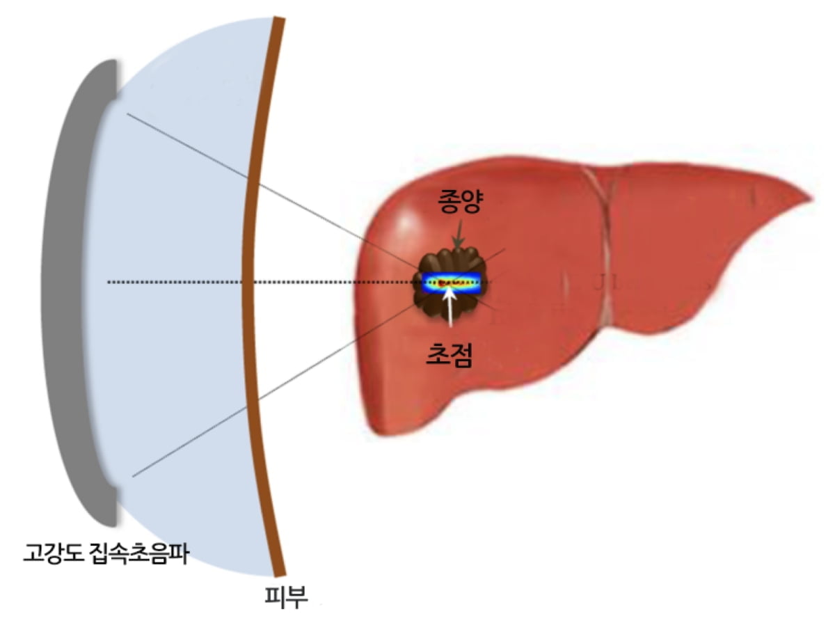 "초강력 초음파로 칼 안대고 암·종양 없앤다"